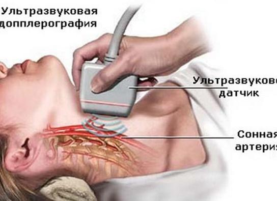 Допплерография сосудов шеи