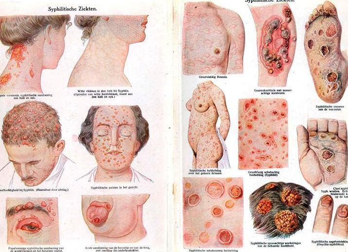 Что такое сифилид