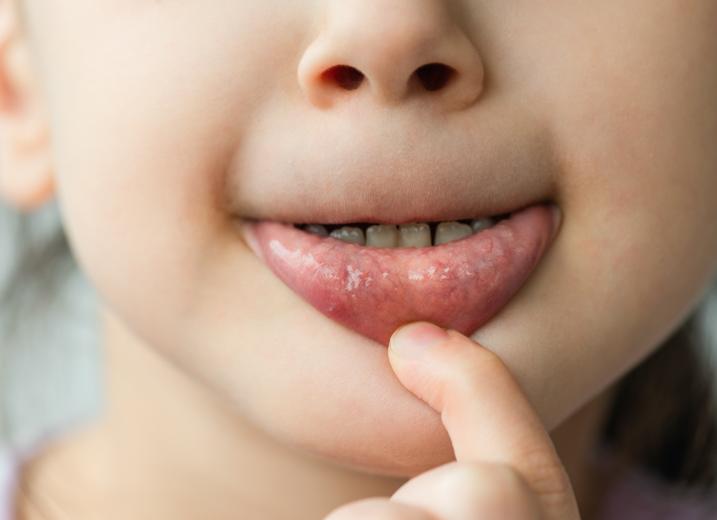 Анализ крови на цитомегаловирус у ребенка Анализ крови на цитомегаловирус у ребенка