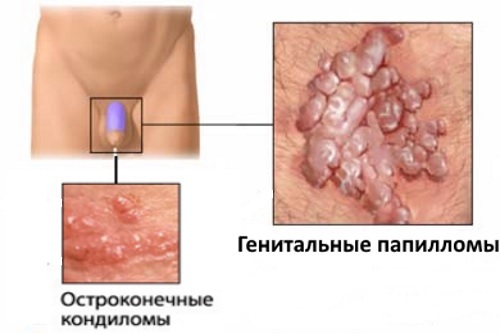 Как впч проявляется у мужчин