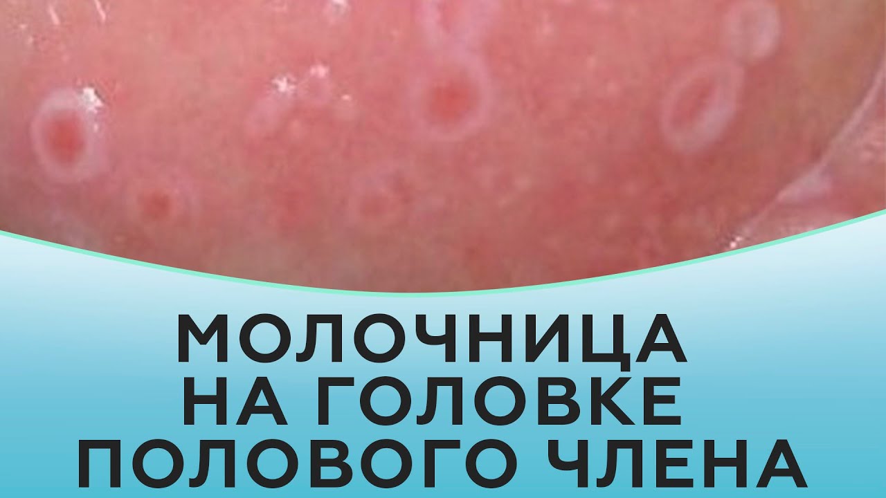 Какие признаки молочницы у мужчин