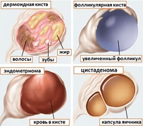 Киста яичника виды кист