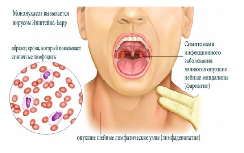 Кровь на мононуклеоз
