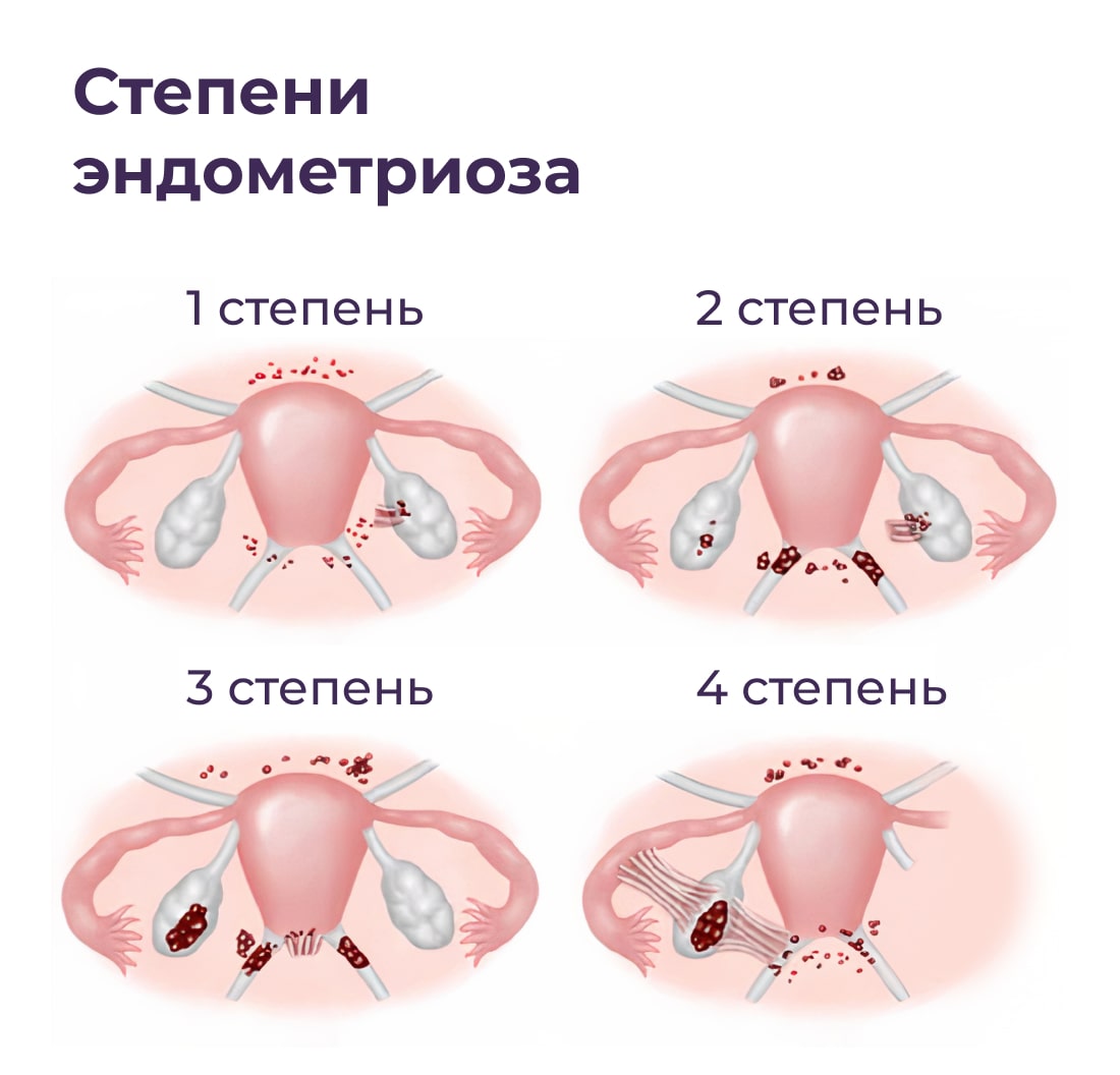 Может ли эндометриоз пройти сам