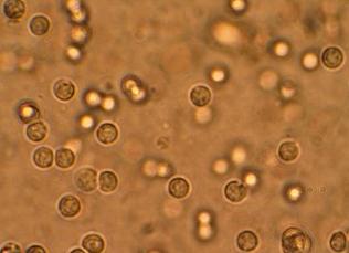 Лейкоциты в моче как снизить Лейкоциты в моче как снизить