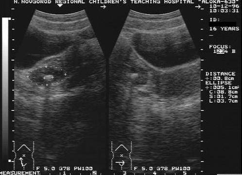 Кальцинаты в яичниках