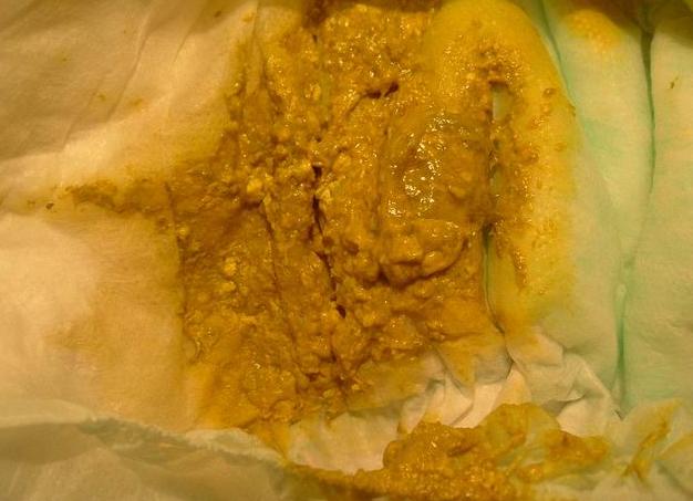 Кал с белыми комочками