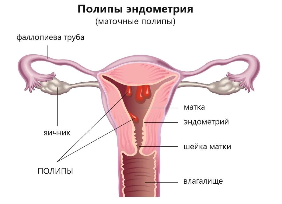 Как лечить полип эндометрия Как лечить полип эндометрия