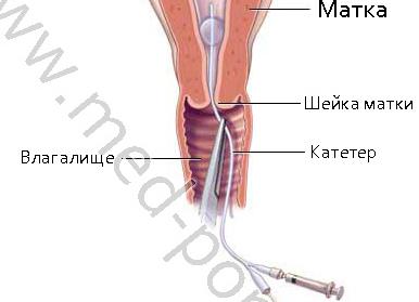 Как делают рентген маточных труб на проходимость Как делают рентген маточных труб на проходимость