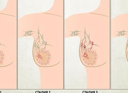 Инфильтрат молочной железы