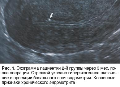 Гиперэхогенное включение в матке