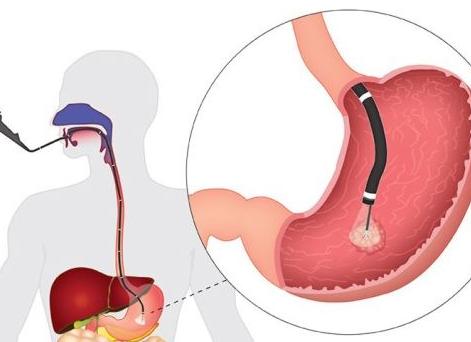 Гастроскопия желудка как делается