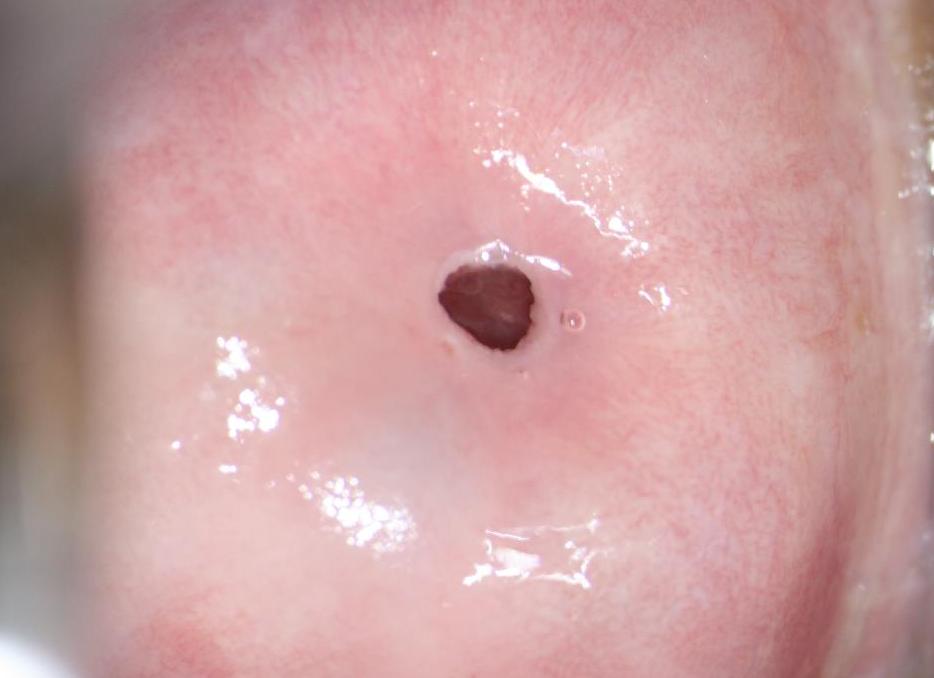 Фото шейка матки при овуляции