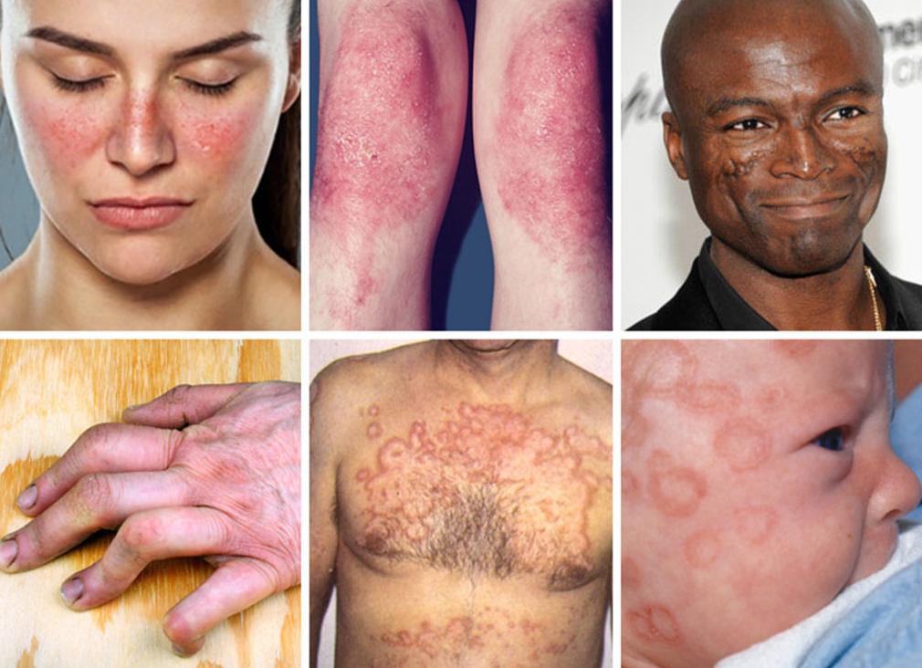 Что такое волчанка болезнь