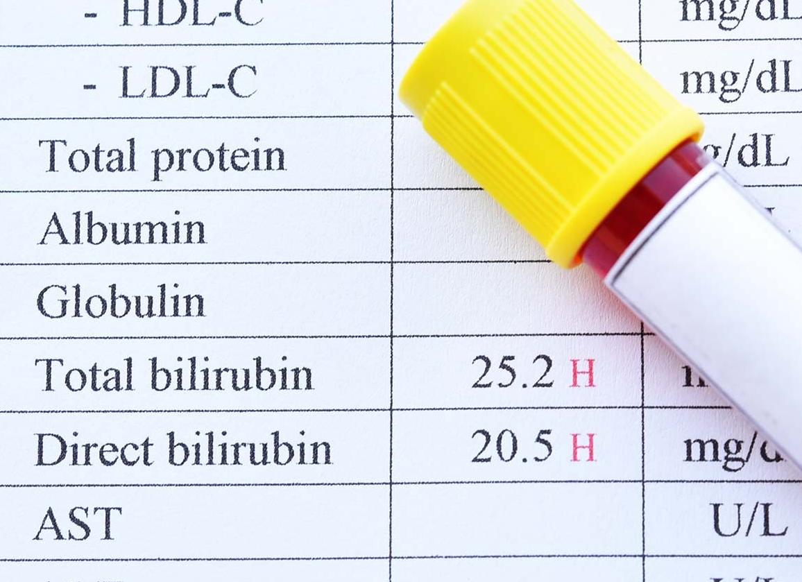 Билирубин у взрослого 28