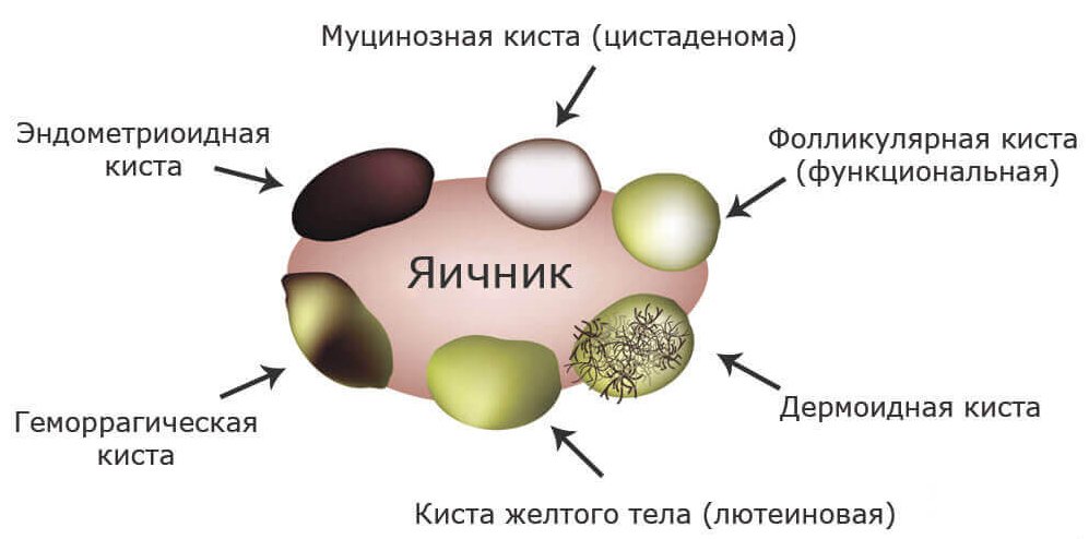 Гипоэхогенное образование в яичнике что это такое