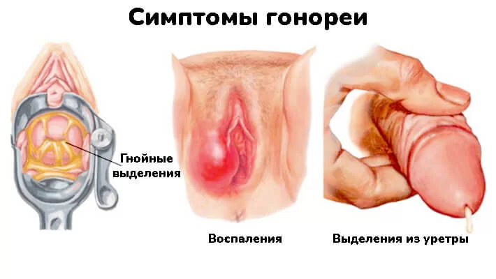 Гонорея у мужчин что это