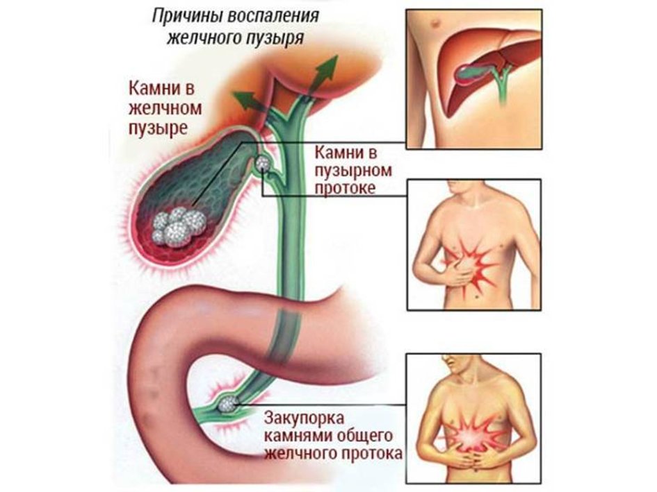 Как снять приступ желчекаменной болезни
