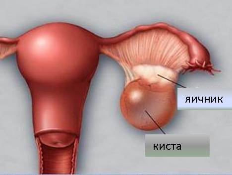Киста от чего появляется