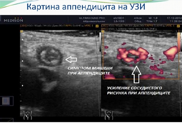 Можно ли по узи определить аппендицит