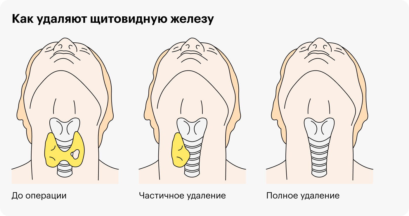 Можно ли родить без щитовидной железы