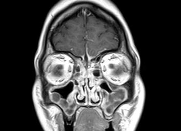 Мрт околоносовых пазух что показывает