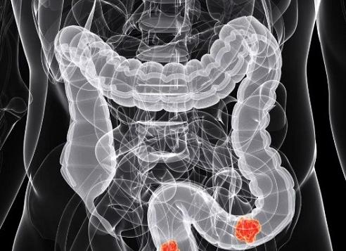 Может ли мрт заменить колоноскопию