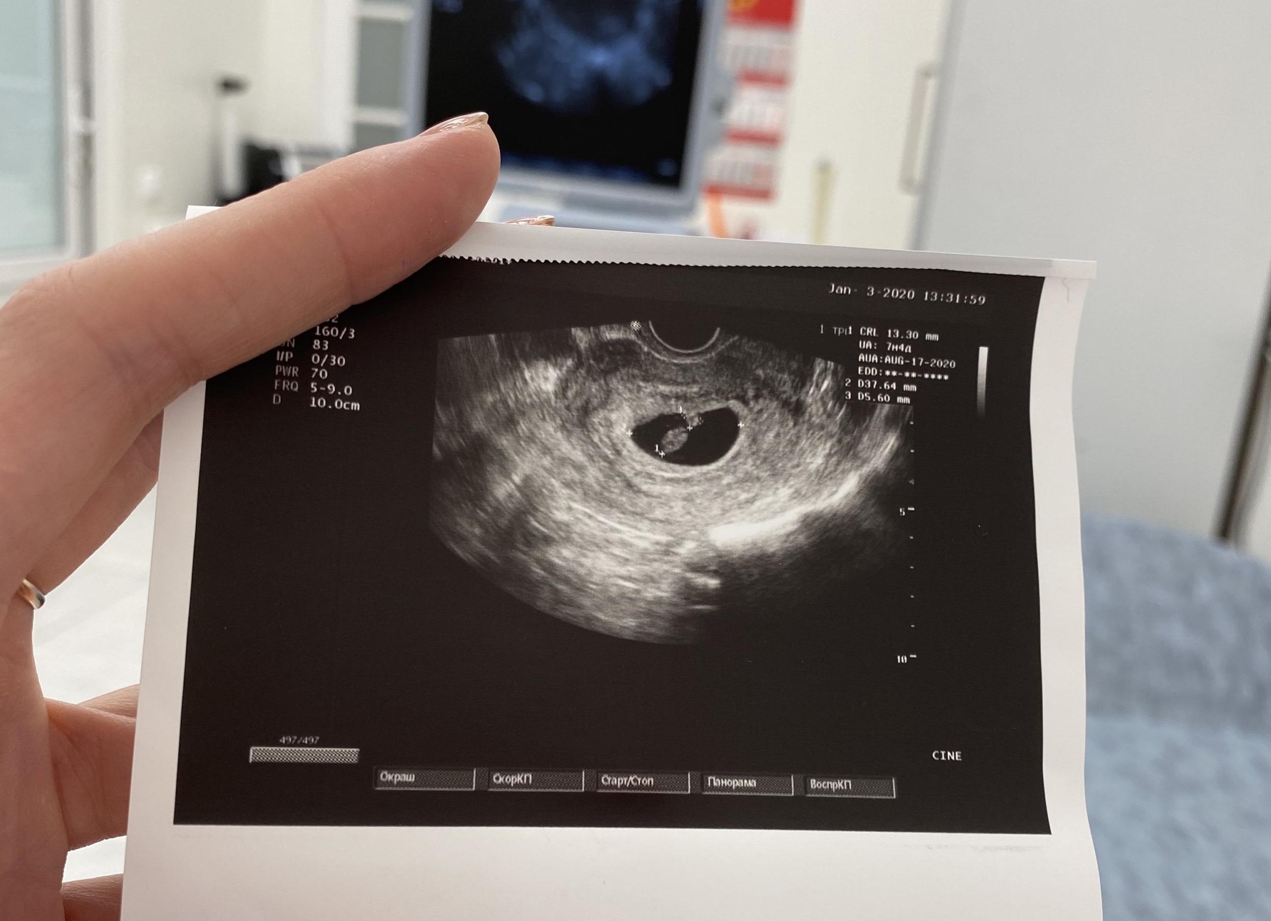 Когда делать первый скрининг Когда делать первый скрининг