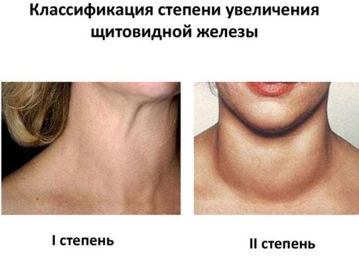 Как понять что увеличена щитовидная железа