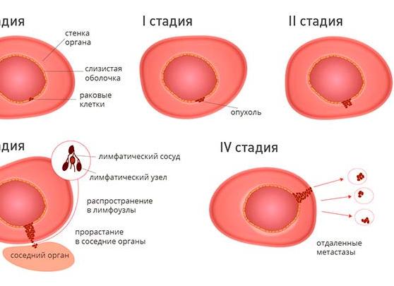 Как называются раковые клетки Как называются раковые клетки