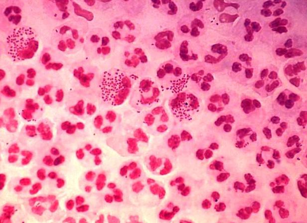 Гонококки в мазке Гонококки в мазке