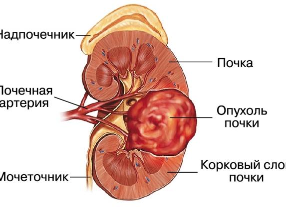 Гипоэхогенное образование в почке что это такое