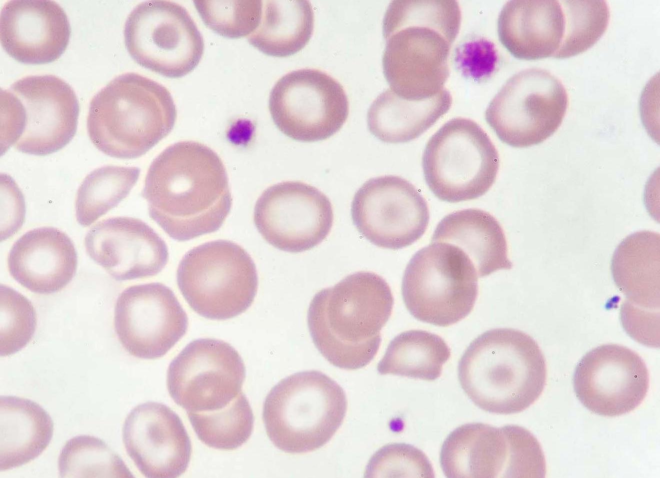 Гиперхромная макроцитарная анемия