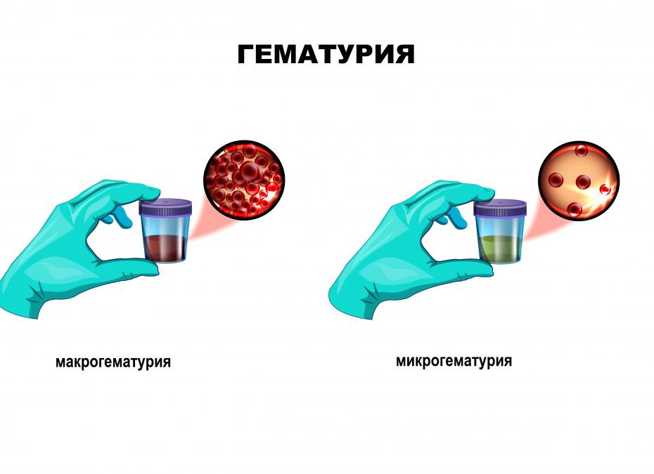 Цвет мочи темный у ребенка
