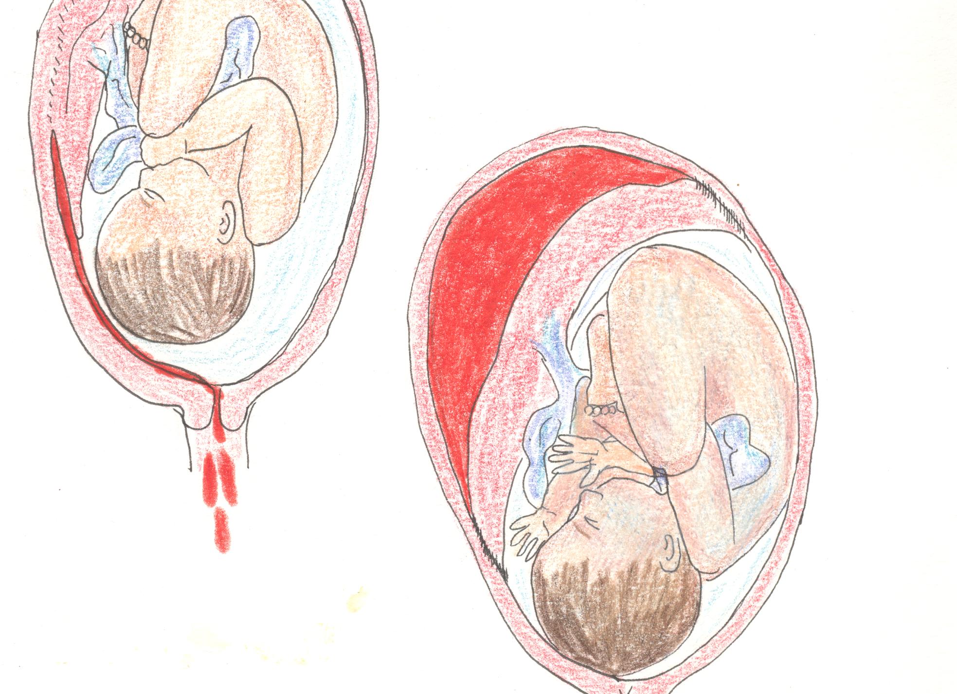 Что такое отслойка плаценты