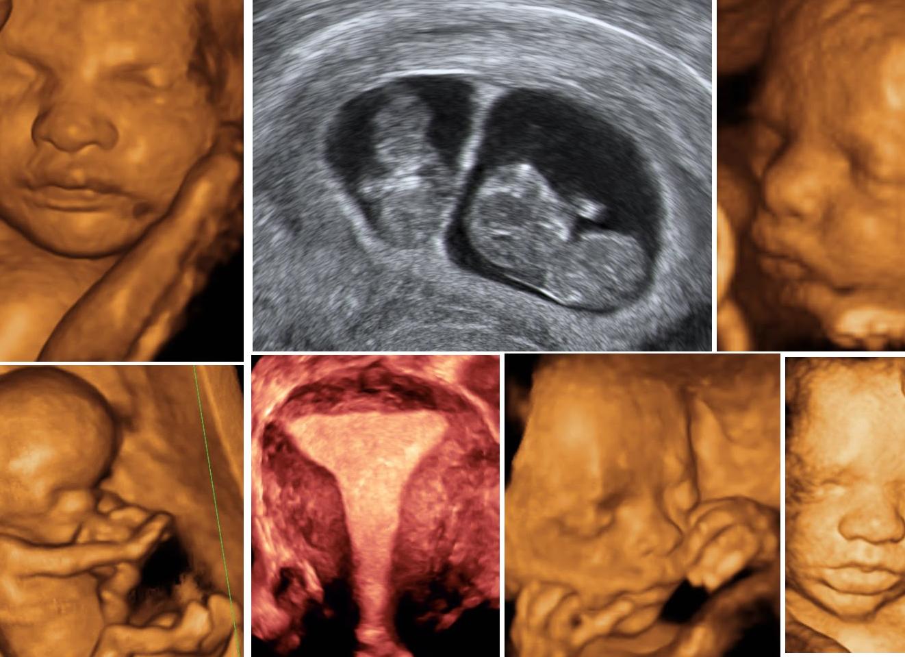 Что такое доплер узи