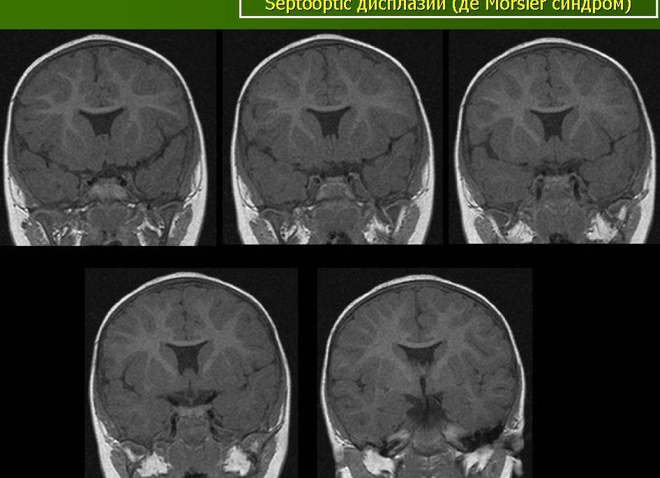 Агенезия прозрачной перегородки