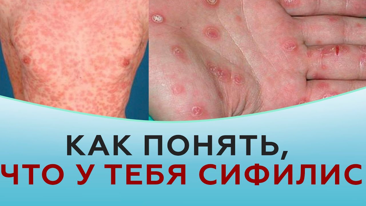 Как проверяют на сифилис