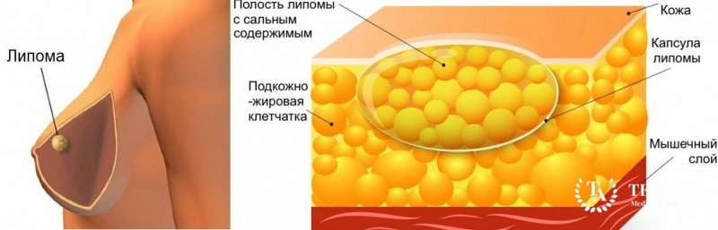 Липома молочной железы что это такое фото