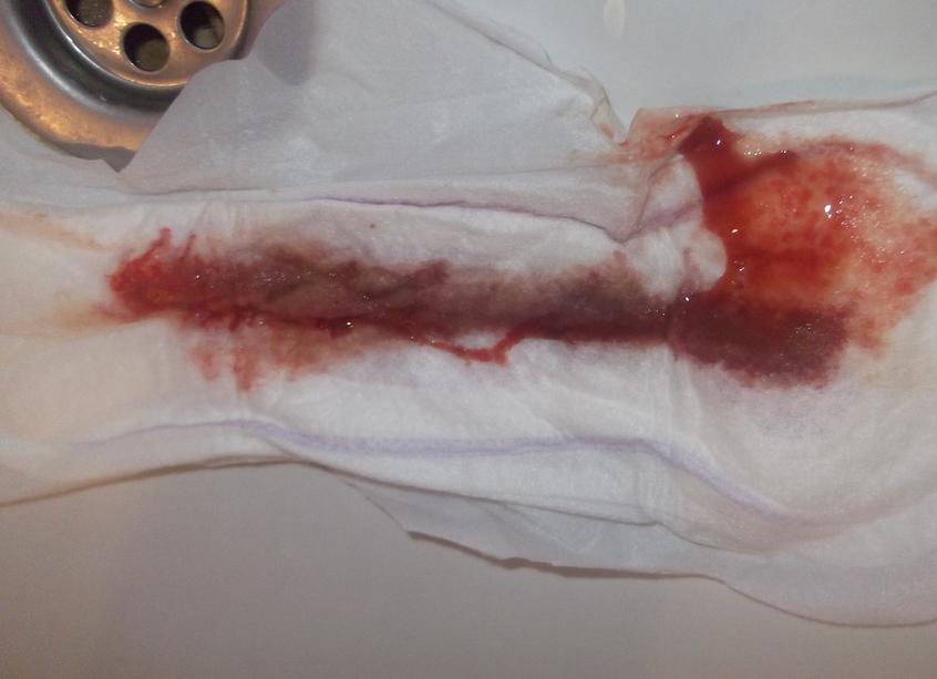 Может ли эрозия кровить