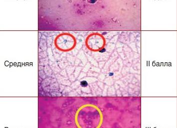 Лецитиновые зерна в секрете простаты Лецитиновые зерна в секрете простаты