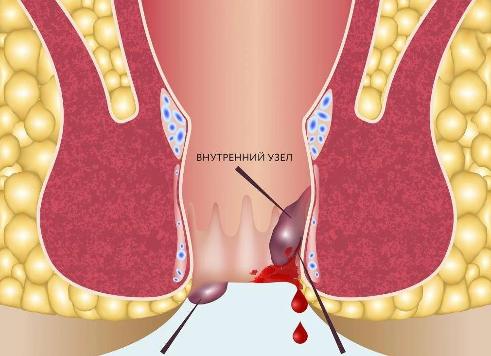 Кровь при геморрое в кале Кровь при геморрое в кале