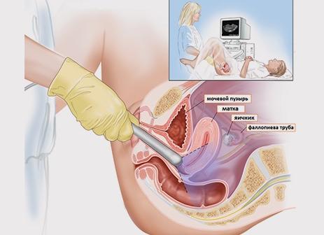 Как расшифровать узи малого таза у женщин