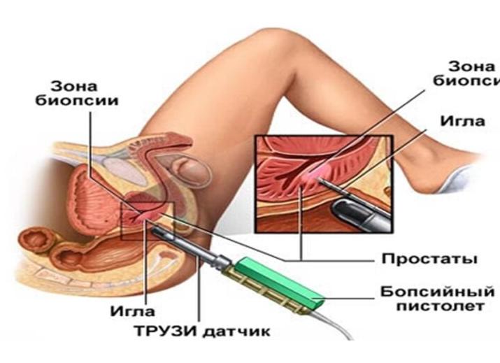 Как подготовиться к трузи предстательной железы