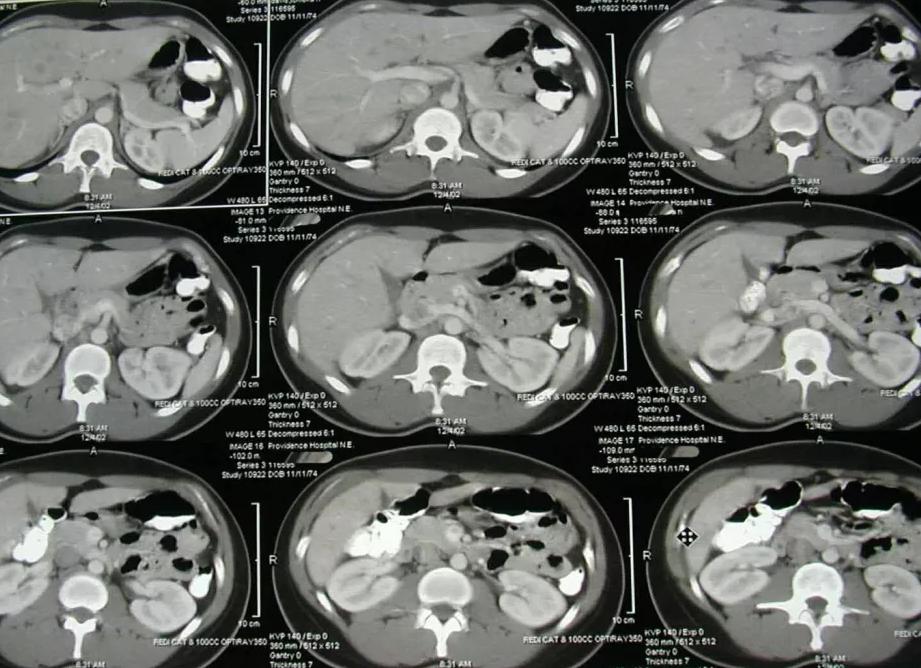 Как готовиться к кт брюшной полости