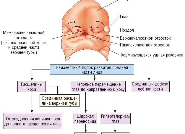 Фронтоназальная дисплазия фото