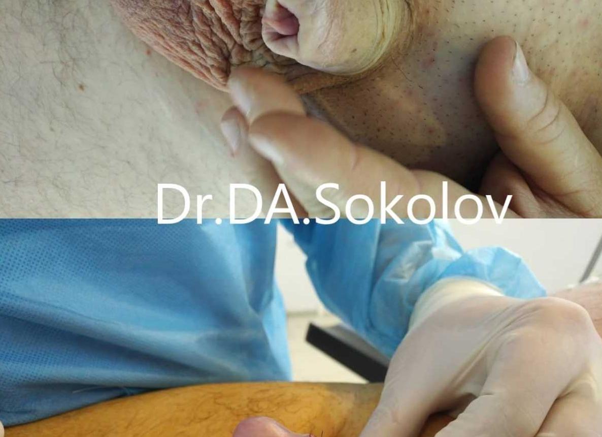 Фимоз фото после операции