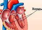 Эктопическая хорда левого желудочка у ребенка