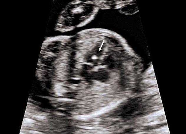 Эхогенный фокус в левом желудочке сердца плода
