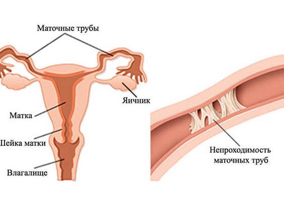 Что такое непроходимость маточных труб